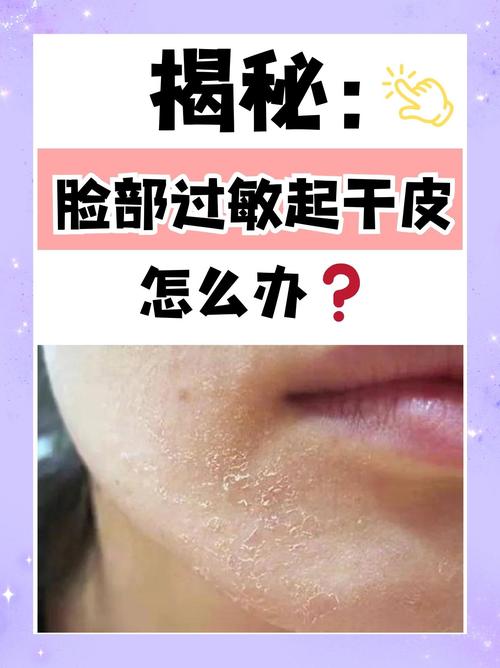 怎样判断是过敏原？日常生活中如何辨别过敏？