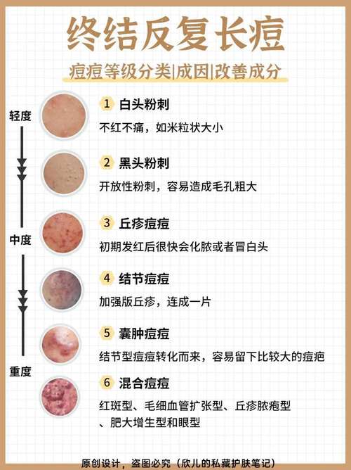 满面痘痘怎么快速消除？试试这些简单方法