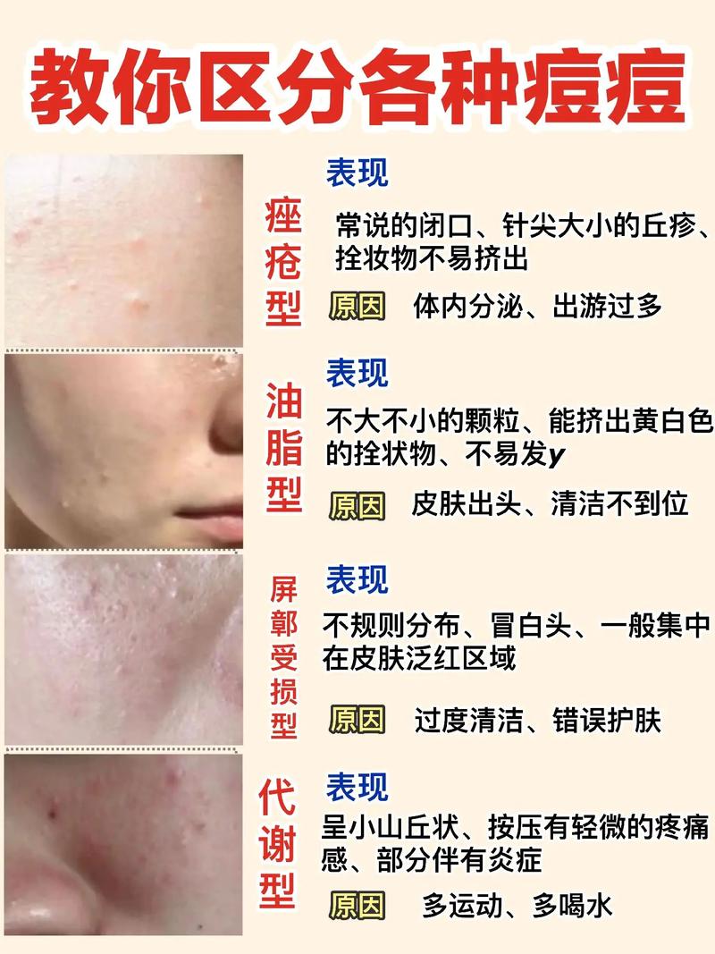 满面痘痘怎么快速消除？试试这些简单方法