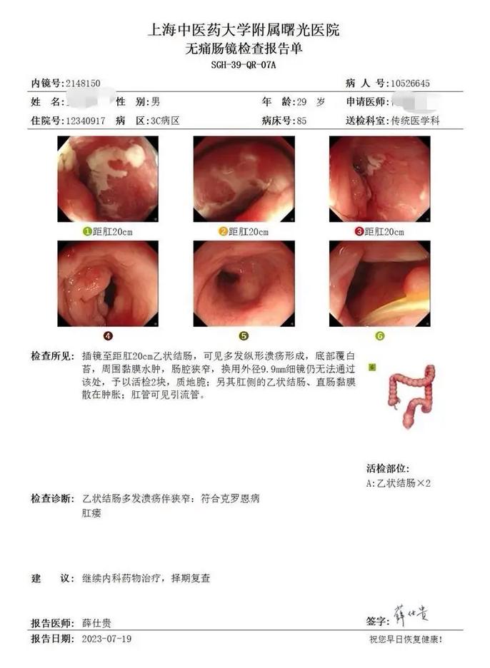 克罗恩病患者的平均寿命是多少？如何延长生命？