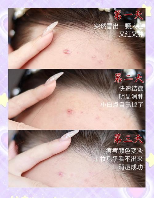 急救！满脸长痘痘怎么调理才能快速消下去？
