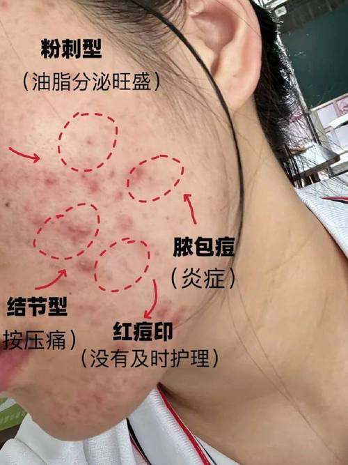 急救！满脸长痘痘怎么调理才能快速消下去？