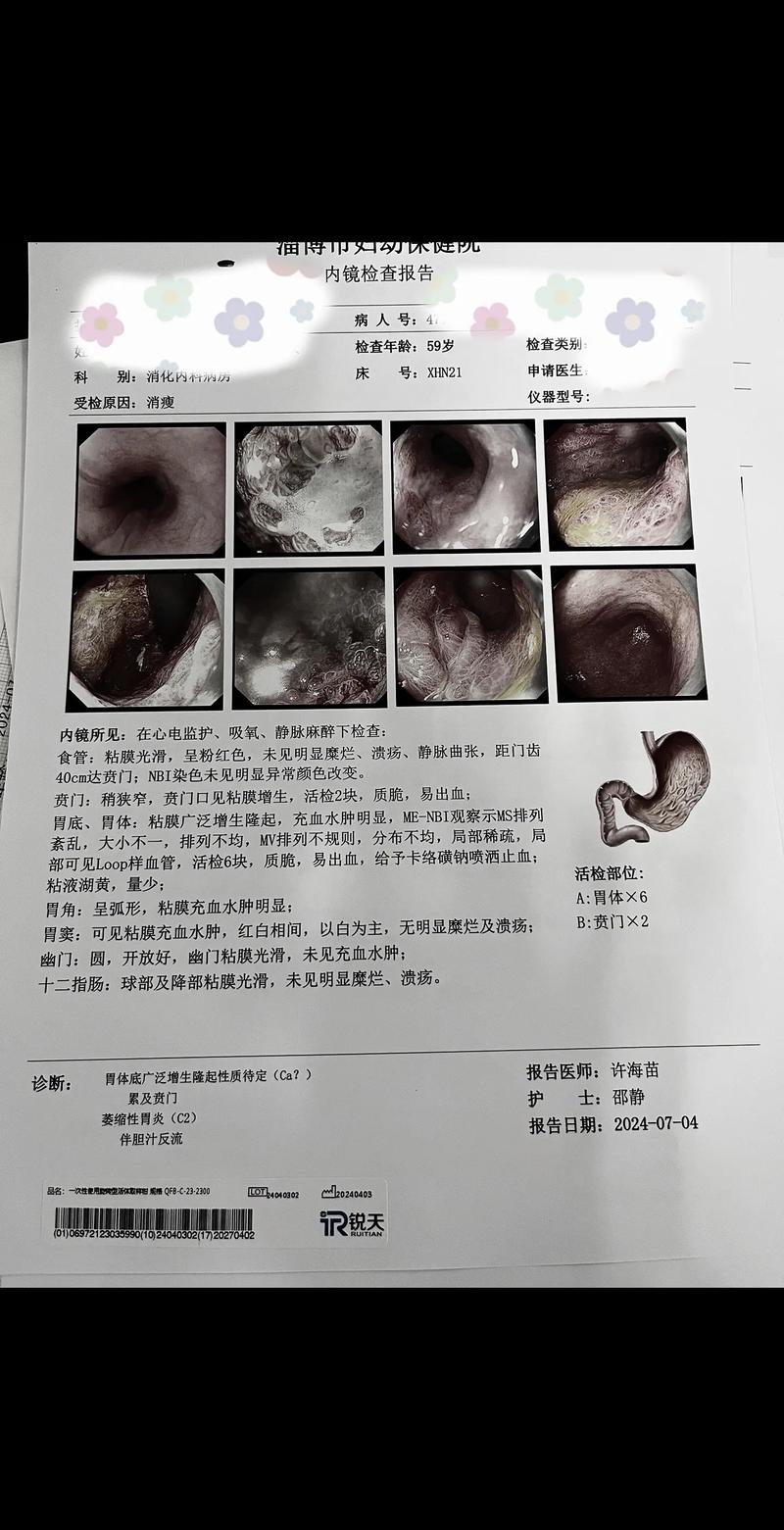 糜烂性胃炎是癌前病变吗？别慌，先了解清楚