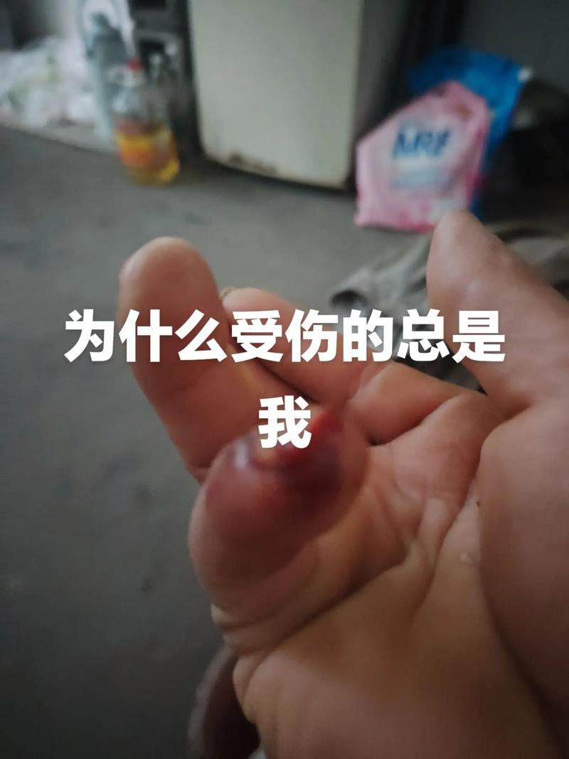 总是受伤？解读为什么受伤的总是我这个难题