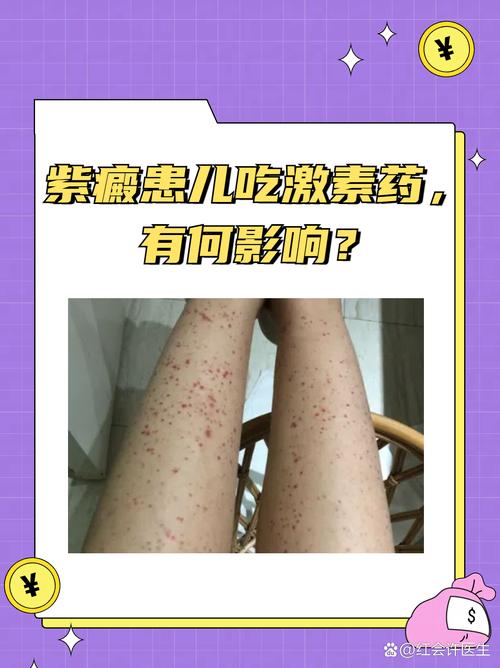 过敏性紫癜的治疗方法有哪些？快速缓解症状