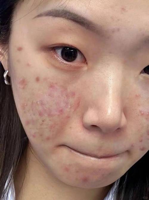 脸上长满痘痘是什么原因？专家教你如何摆脱痘痘