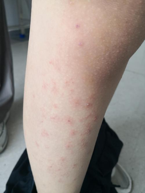 过敏症状都有哪些？全面解读过敏的各种表现