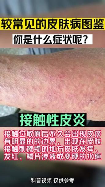 过敏症状都有哪些？全面解读过敏的各种表现
