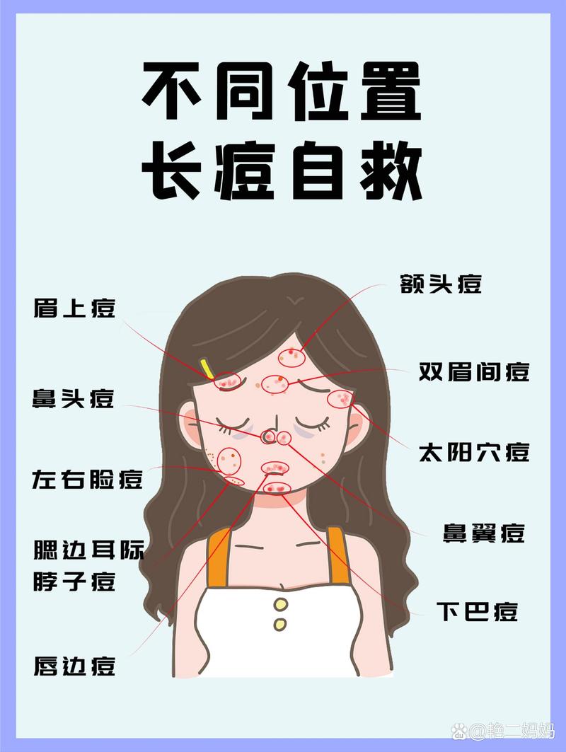 脸上长满痘痘是什么原因？专家教你如何摆脱痘痘