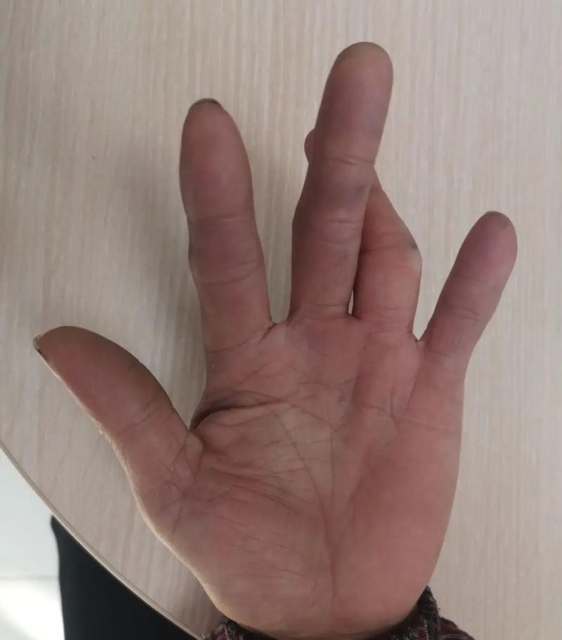 你的手指会脱臼吗？手指脱臼的常见原因及预防