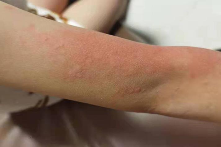 过敏症状都有哪些？全面解读过敏的各种表现