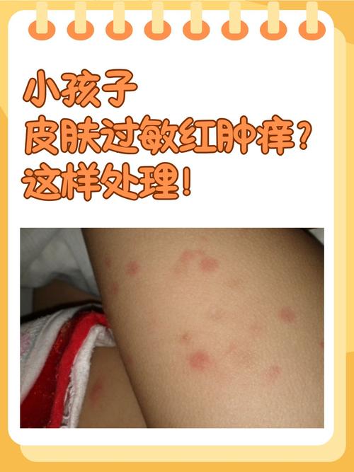 过敏症状都有哪些？全面解读过敏的各种表现