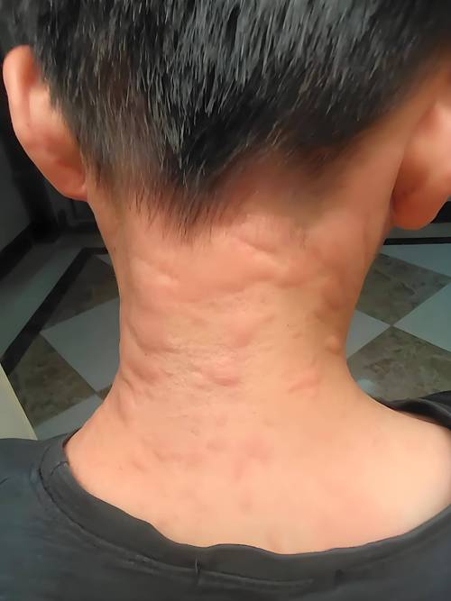 过敏原检测挂什么科?皮肤科、呼吸科还是变态反应科?