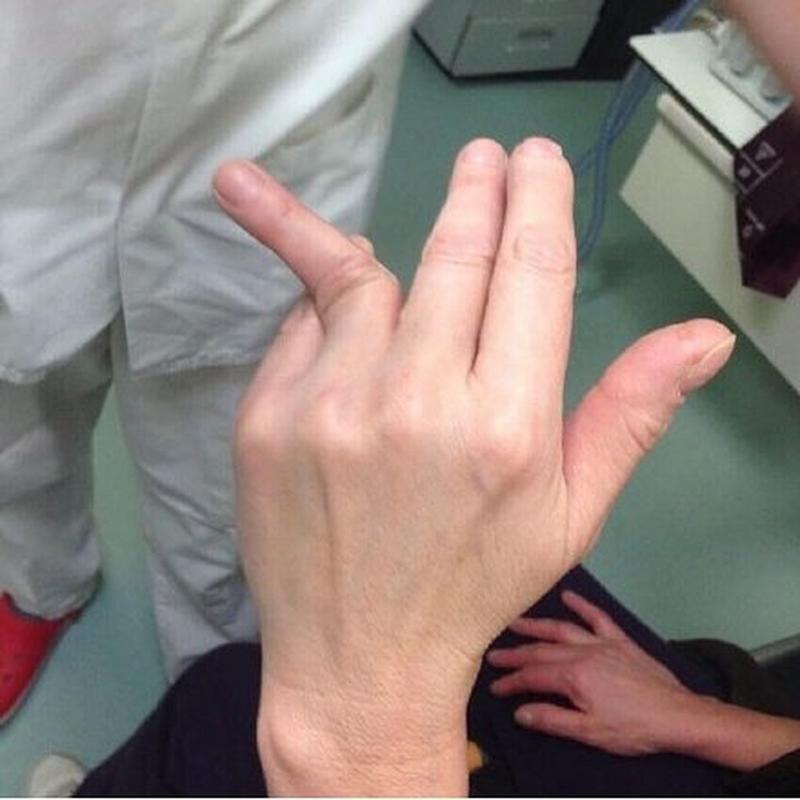 你的手指会脱臼吗？手指脱臼的常见原因及预防