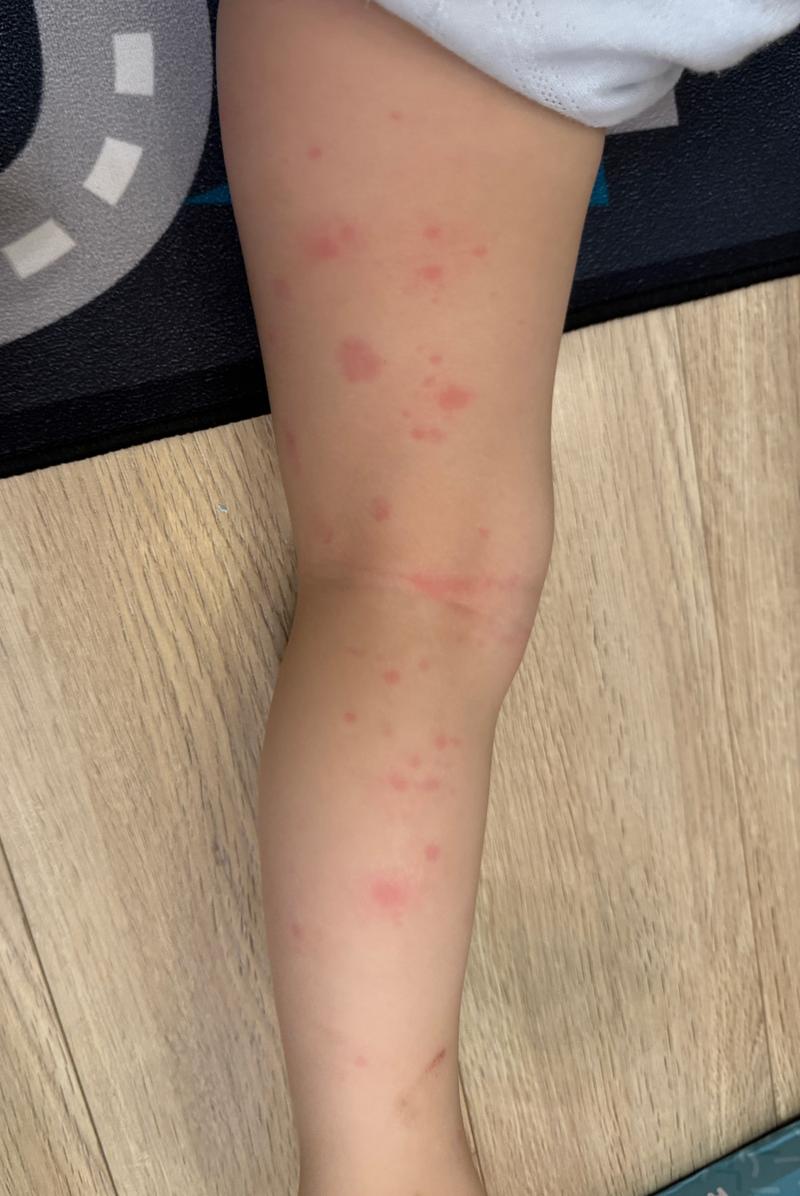 过敏症状都有哪些？全面解读过敏的各种表现
