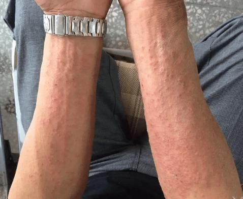 过敏原检测挂什么科?皮肤科、呼吸科还是变态反应科?