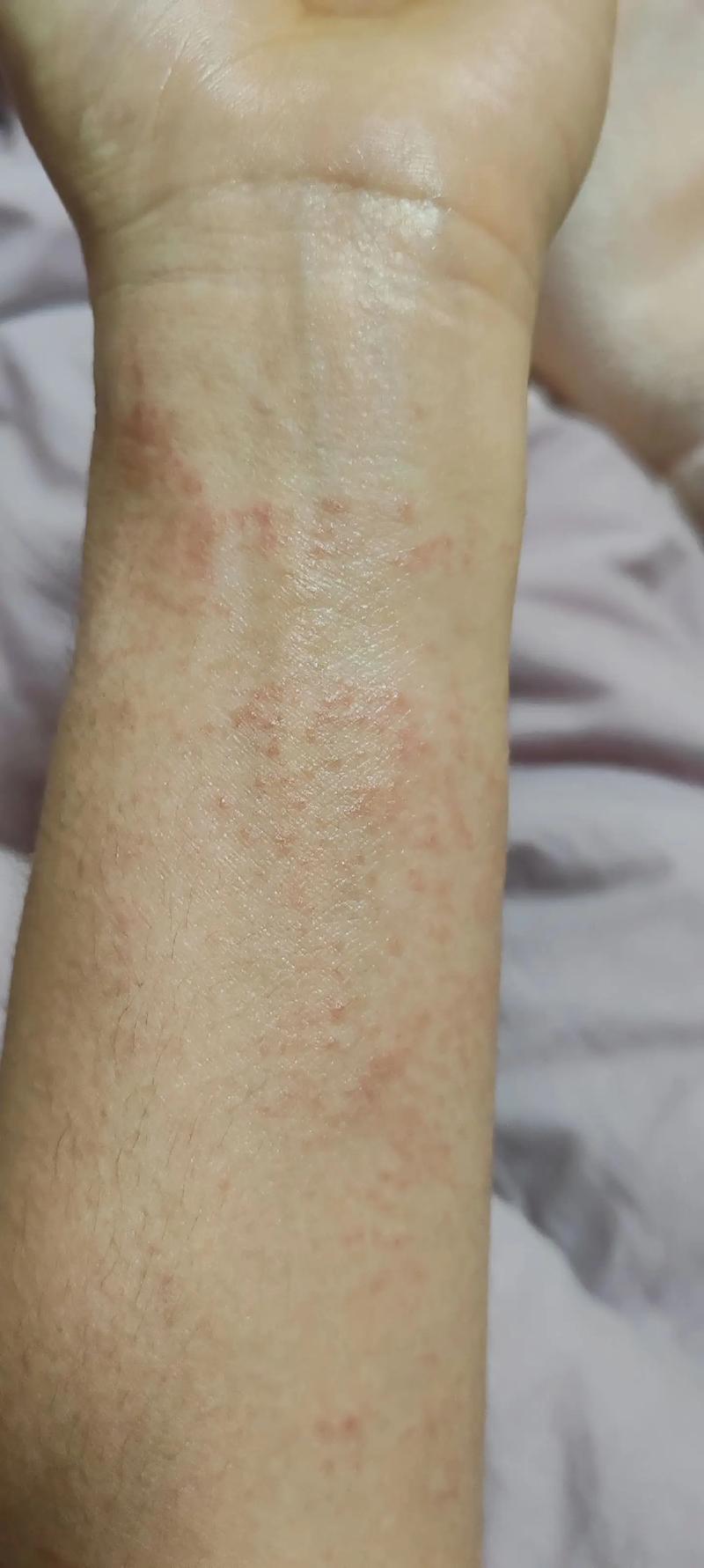 过敏症状都有哪些？全面解读过敏的各种表现