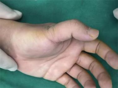 你的手指会脱臼吗？手指脱臼的常见原因及预防