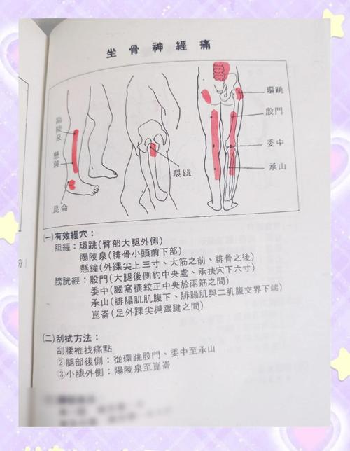 坐骨神经痛是哪个部位疼？日常避痛实用小窍门！