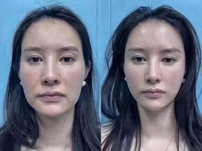 ipl5效果怎么样？真实案例对比提升方法！