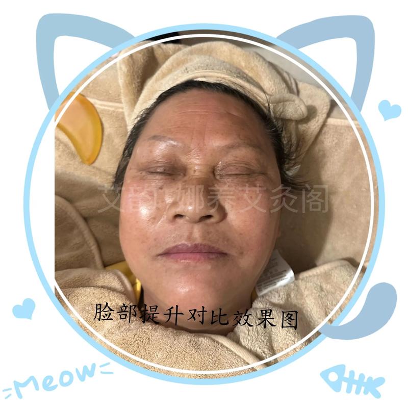 ipl5效果怎么样？真实案例对比提升方法！