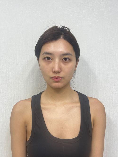 ipl5效果怎么样？真实案例对比提升方法！