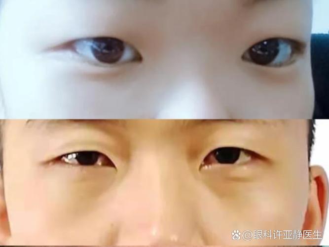 单眼皮父母生双眼皮小孩？关于遗传的真相别错过