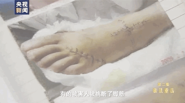 挑断脚筋真实图片在哪找？行内人推荐权威来源！